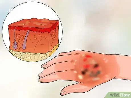 Image titled Treat a Hot Water Spill on Your Skin Step 3