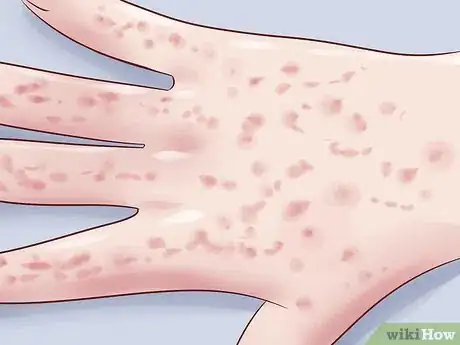 Image titled Treat Dry Hands Step 14