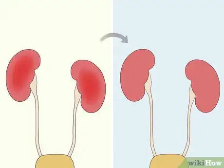 Image titled Treat Hypocalcemia Step 18