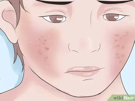 Image titled Know if Your Child Has Scarlet Fever Step 8