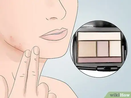 Image titled Cover Inflamed Pimples Step 6
