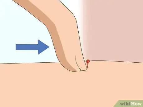 Image titled Soothe Bug Bites Step 1