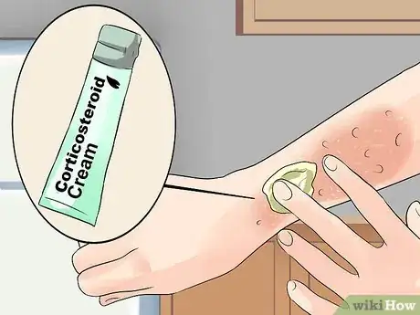 Image titled Avoid Psoriasis Vaccine Complications Step 9