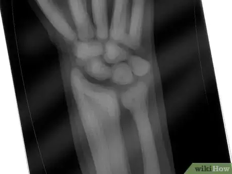 Image titled Prevent Thyroid Cancer Step 1