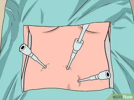 Image titled Find a Kidney Donor Step 8