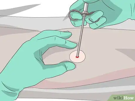 Image titled Diagnose ALS (Amyotrophic Lateral Sclerosis) Step 6