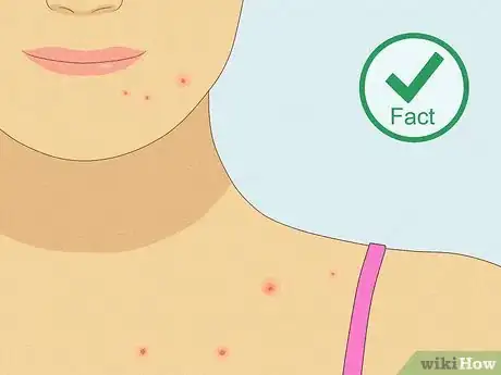 Image titled Myths About Pimples Step 2