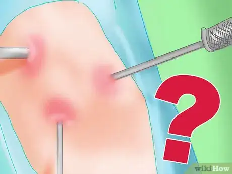 Image titled Get Rid of Knee Pain from Running Step 13