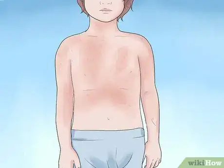 Image titled Know if Your Child Has Scarlet Fever Step 7