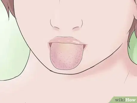 Image titled Know if Your Child Has Scarlet Fever Step 9