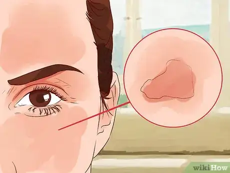 Image titled Get Collagen Induction Therapy Step 7