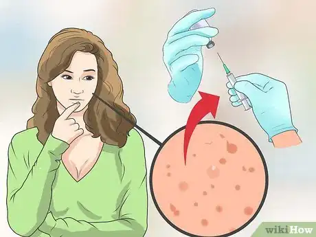 Image titled Treat Cystic Acne Naturally Step 19