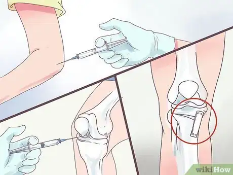 Image titled Treat Degenerative Arthritis Step 7