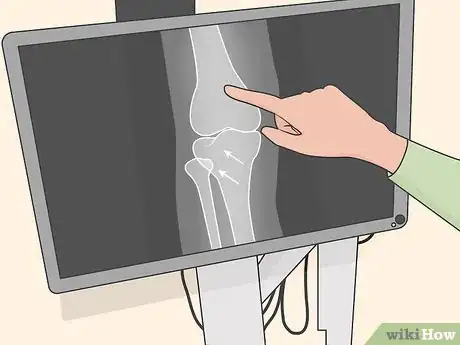 Image titled Diagnose and Treat a Tibial Plateau Fracture Step 06