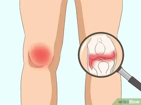 Image titled Diagnose Arthritis Step 6