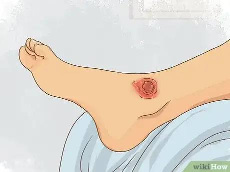 Image titled Treat Complications of Sickle Cell Disease (SCD) Step 4