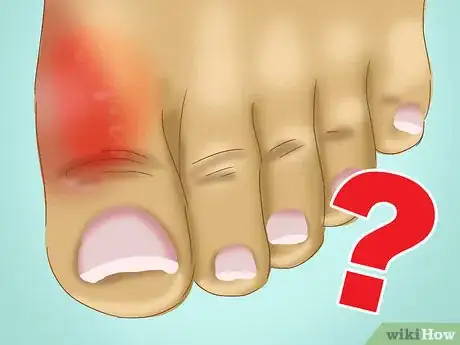 Image titled Relieve a Sore Damaged Toe Step 9