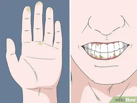 Image titled Spot Early Signs of Anorexia Step 4