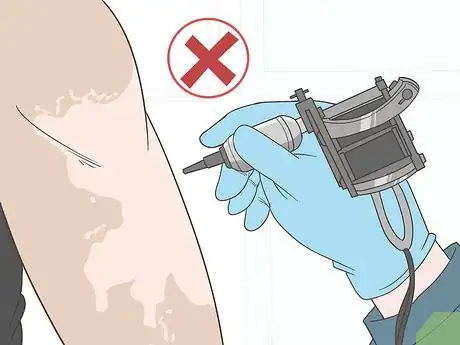 Image titled Prevent Vitiligo from Getting Worse Step 4