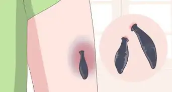 Make a Bruise Go Away Faster