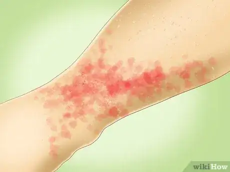 Image titled Prevent Hives Step 9