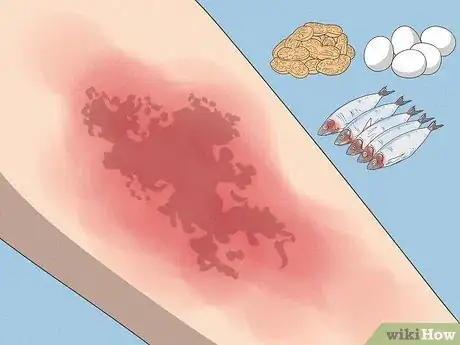 Image titled Improve Eczema with Diet Step 1