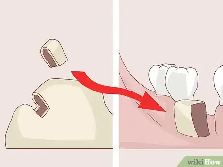 Image titled Know What to Expect when Getting a Tooth Implant Step 10