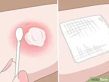 Image titled Treat Spider Bites on Kids Step 5