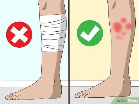 Image titled Heal Red Skin Step 2