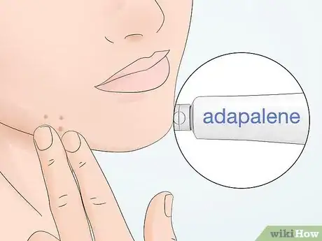 Image titled Clear Pustules on Your Face Step 10