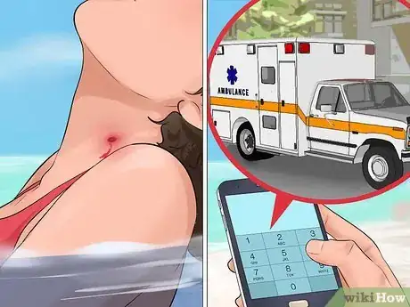 Image titled Identify and Treat Injuries From Stingrays and Sea Urchins Step 2