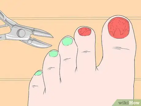 Image titled Trim Toenails with Fungus Step 6