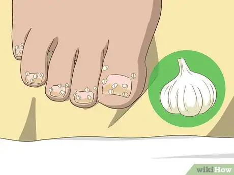Image titled Treat Toe Nail Fungus Step 5