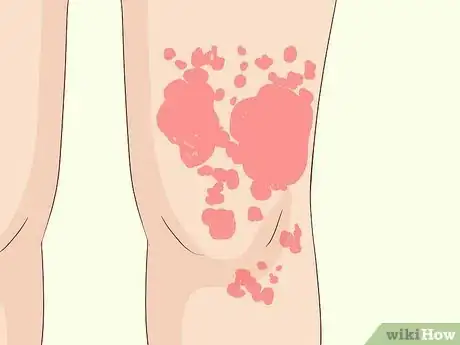 Image titled Treat Mast Cell Activation Syndrome Step 5