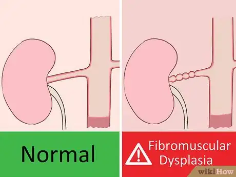 Image titled Prevent Renal Artery Stenosis Step 13
