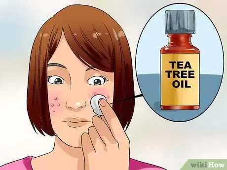 Image titled Clear up Acne With Hydrogen Peroxide Step 7