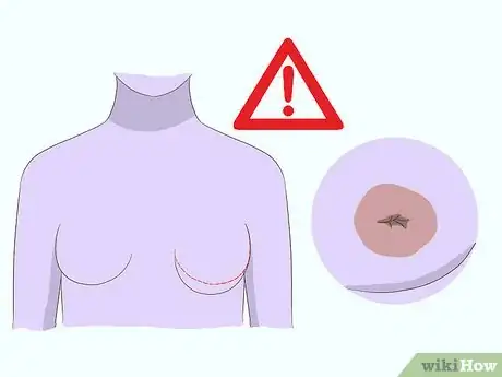 Image titled Diagnose Breast Cancer Step 2
