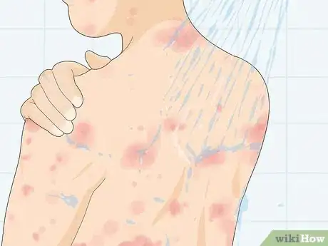 Image titled Recognize Hives (Rash) Step 10