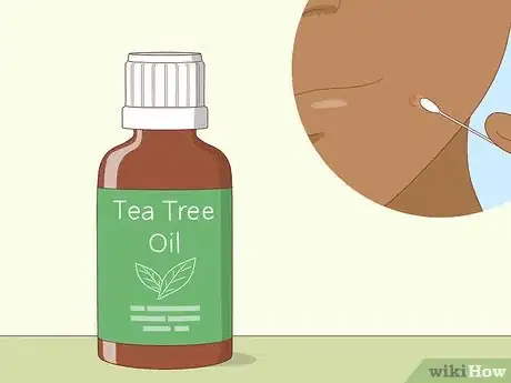Image titled Avoid Blind Pimples Step 9