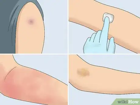 Image titled Inject Into a Vein Step 18