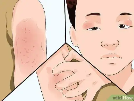 Image titled Identify a Seasonal Allergy Reaction in Young Children Step 3