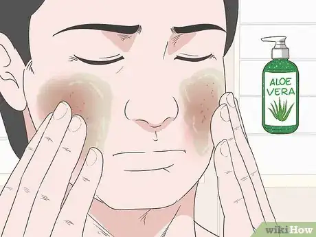 Image titled How to Treat Rosacea Can Herbal Remedies Help Step 6