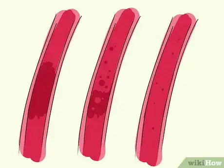 Image titled Treat an Aneurysm Step 11