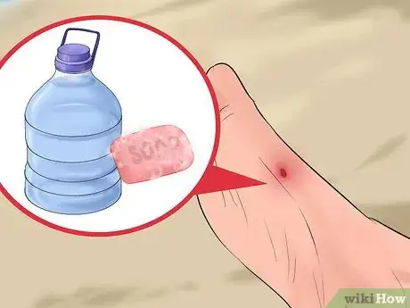Image titled Identify and Treat Injuries From Stingrays and Sea Urchins Step 6
