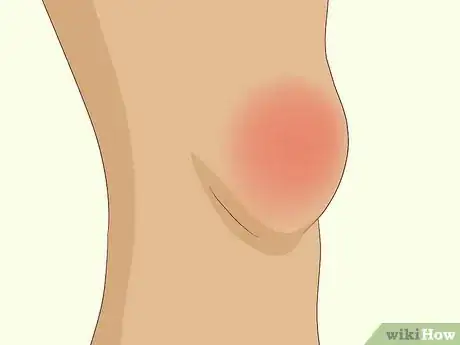 Image titled Treat Campylobacter Step 7