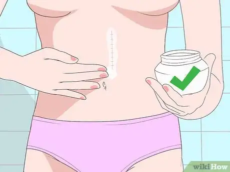 Image titled Treat Adhesions Step 12