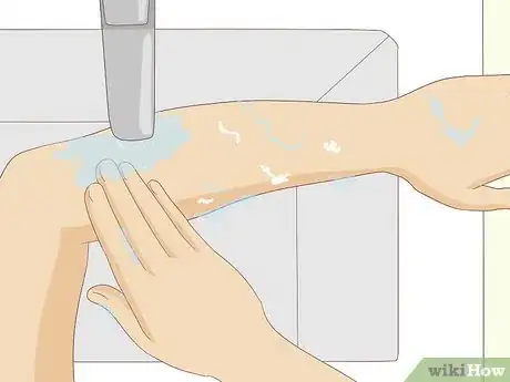 Image titled Prevent Surgical Site Infections Step 13