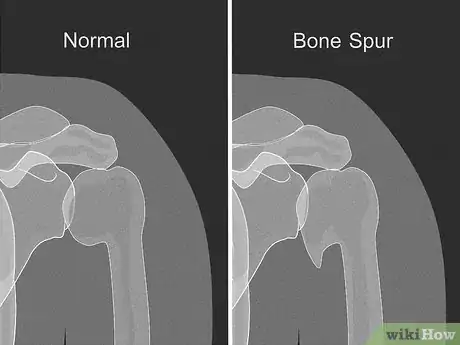 Image titled Prevent Arthritis in Your Shoulder Step 10