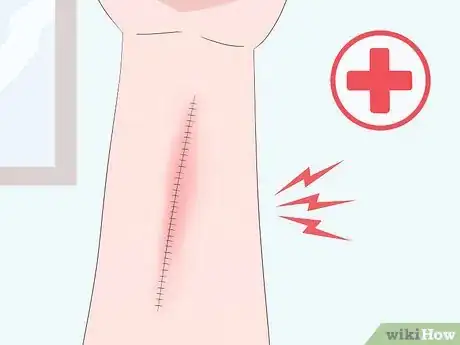 Image titled Prevent Surgical Site Infections Step 11