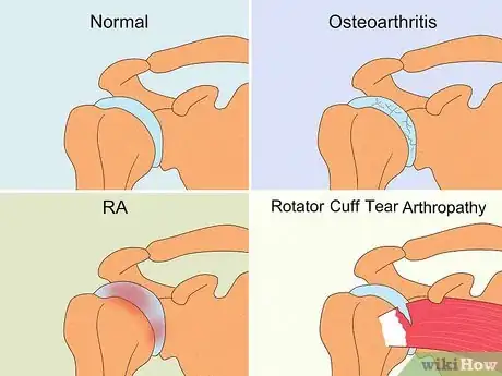 Image titled Prevent Arthritis in Your Shoulder Step 11